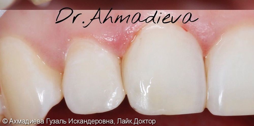 Лечение среднего кариеса 11, 12 зубов, реставрация - фото №2