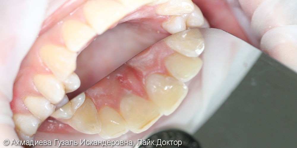 Лечение среднего кариеса 2.1, 1.1 зубов - фото №2