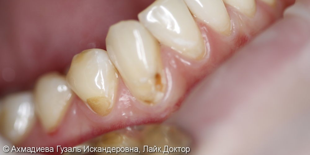 Лечение клиновидного дефекта 4.3, 4.4 зубов - фото №1