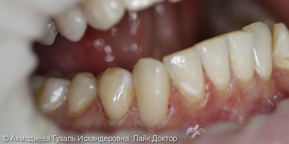 Лечение клиновидного дефекта 4.3, 4.4 зубов - фото №2