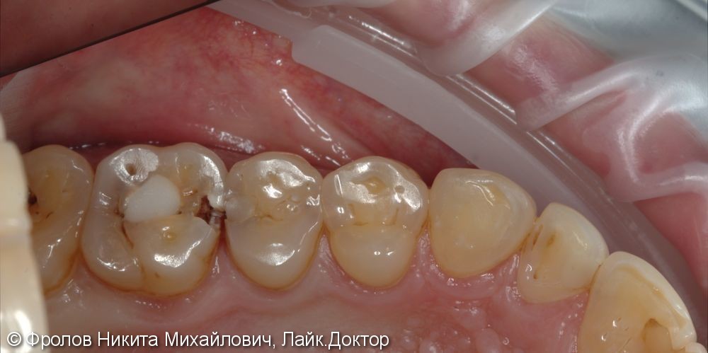 Лечение кариеса зубов 2.5, 2.6. - фото №1