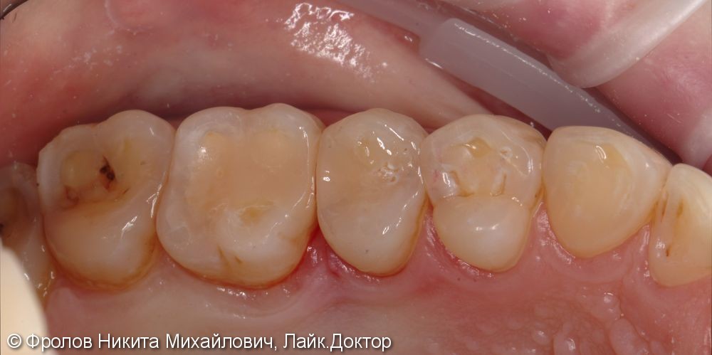 Лечение кариеса зубов 2.5, 2.6. - фото №3
