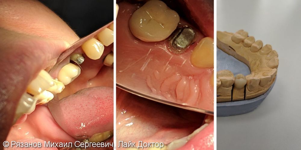 Восстановление зуба металлокерамической коронкой - фото №1
