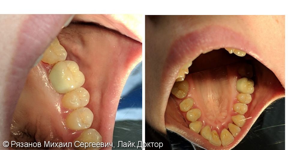 Восстановление зуба коронкой из диоксида циркония - фото №2