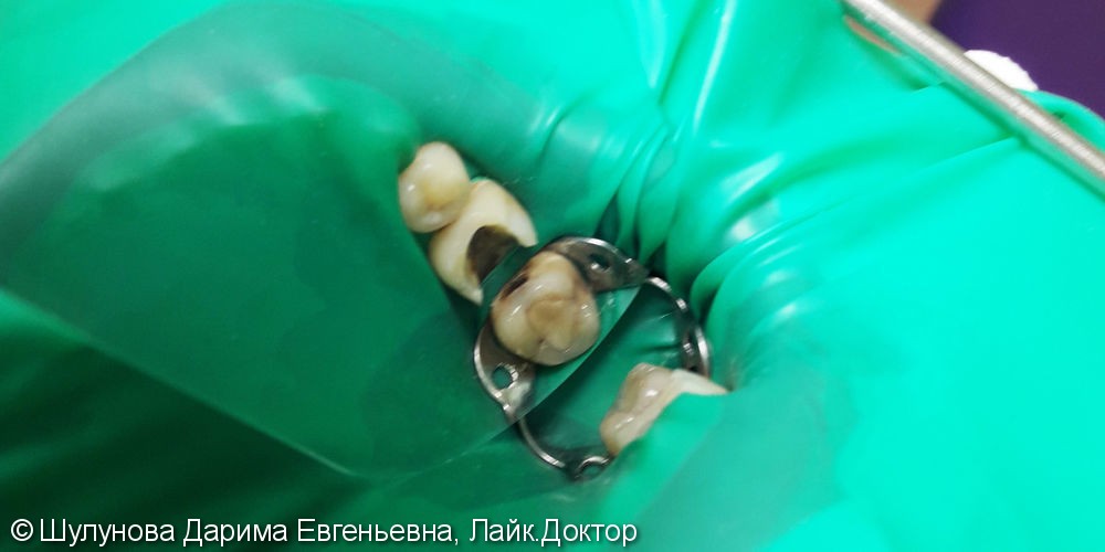 Лечение и реставрация зубов №16/№17 фотополимером российского производства - фото №1