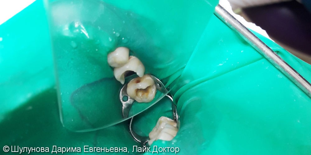 Лечение и реставрация зубов №16/№17 фотополимером российского производства - фото №2