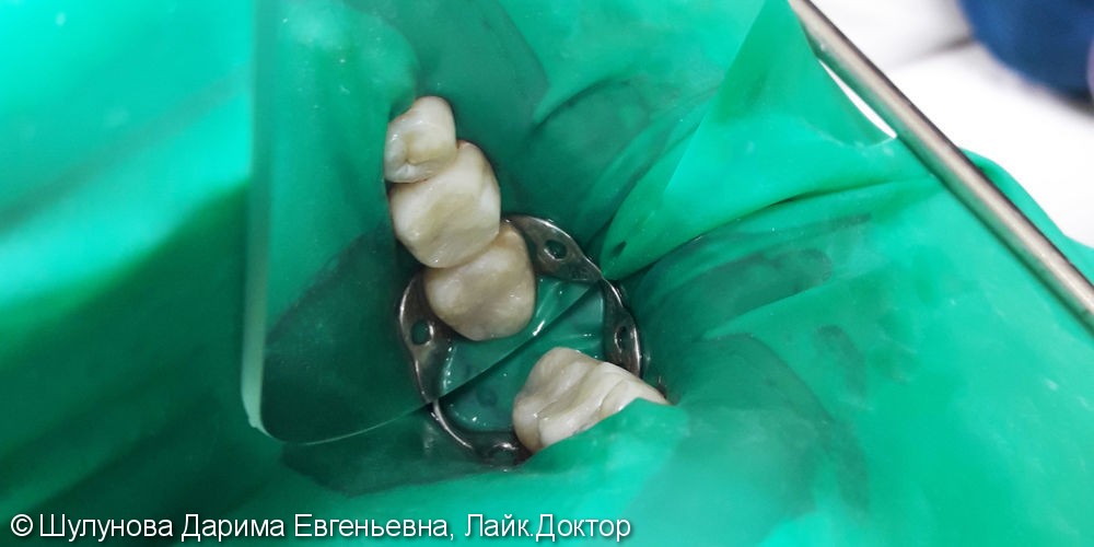 Лечение и реставрация зубов №16/№17 фотополимером российского производства - фото №3