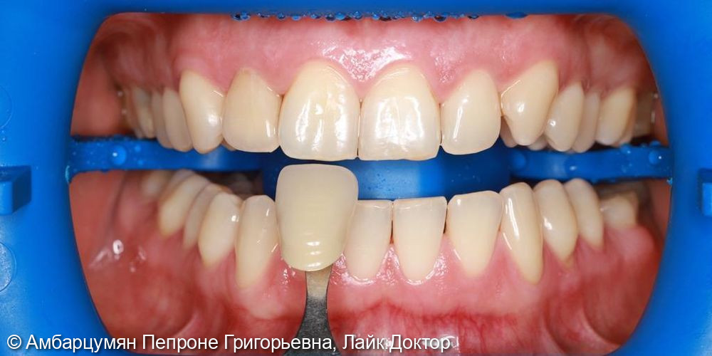 Отбеливание зубов ZOOM - фото №1