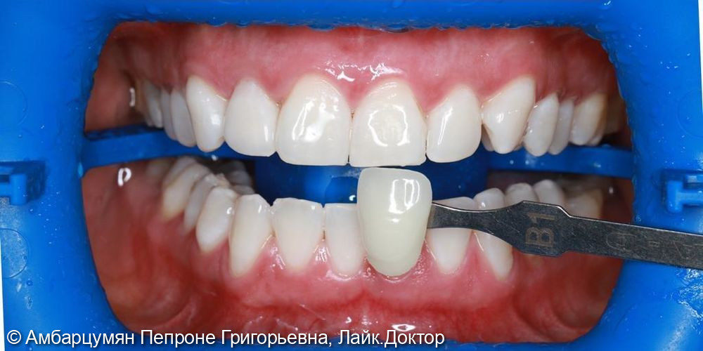 Отбеливание зубов ZOOM - фото №2