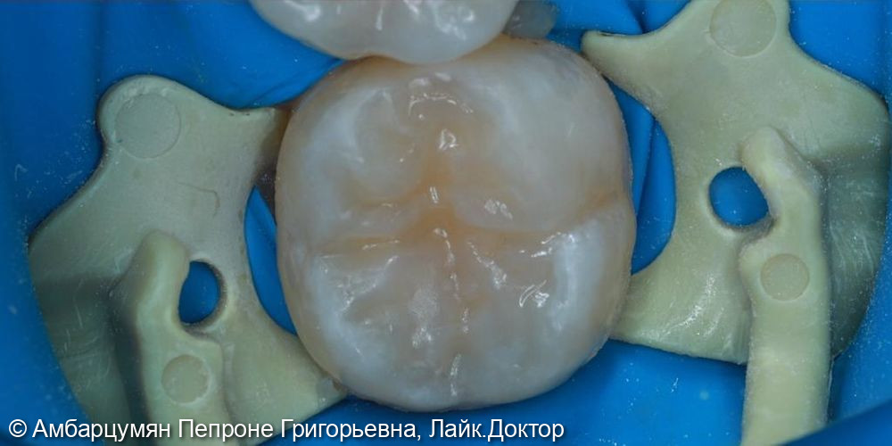 Лечение среднего кариеса с последующим анатомическим восстановлением зуба - фото №2