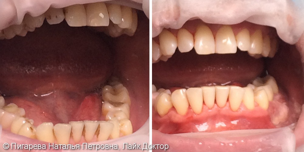 Профессиональная гигиена полости рта, до и результат после - фото №1