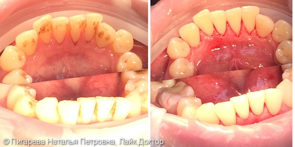 Профессиональная гигиена полости рта, до и результат после - фото №2