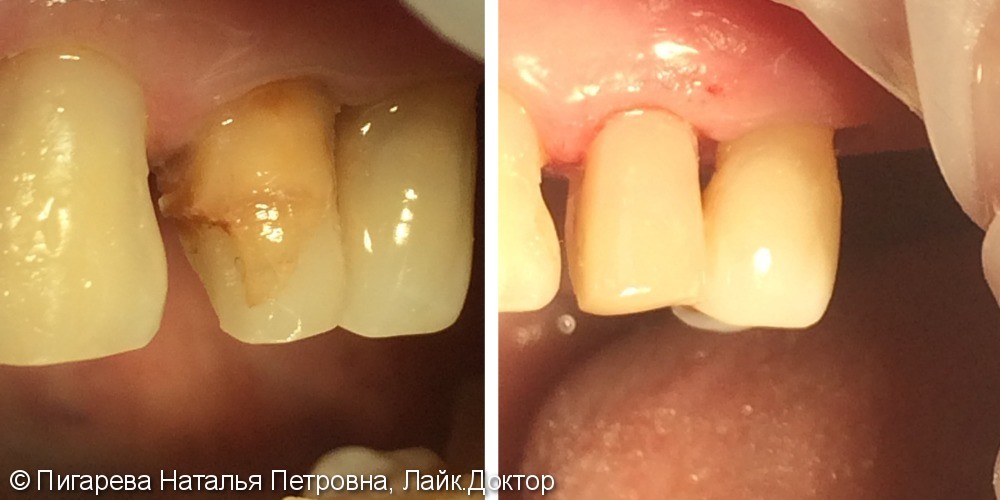 Лечение глубокого кариеса зуба 2.4 - фото №1