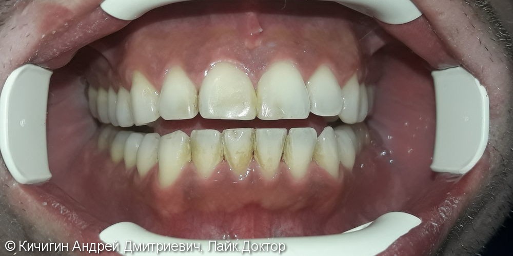 Результат удаления зубного налета - фото №1