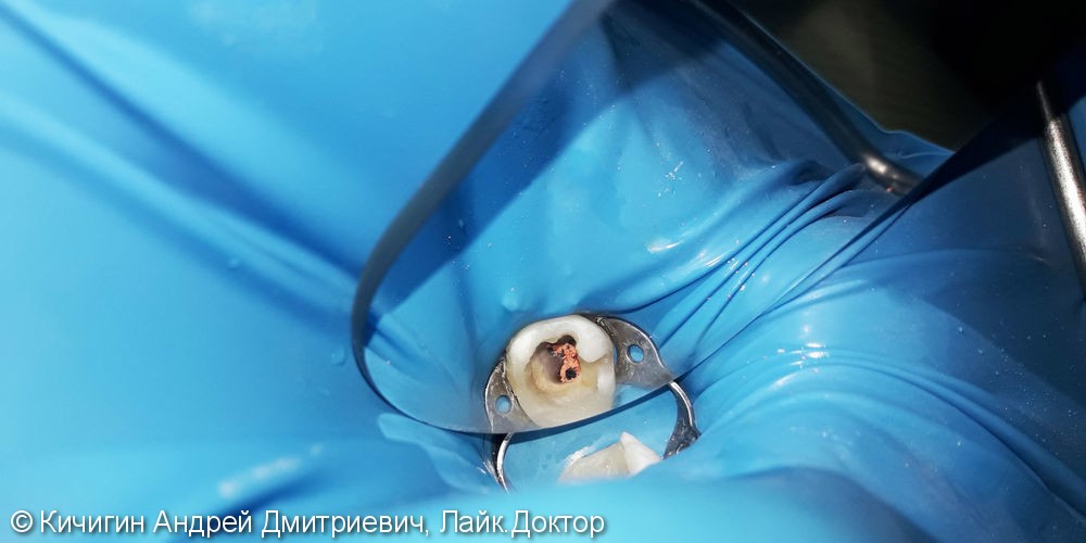 Лечение и реставрация зуба №37 фотополимером Ceram-X - фото №1