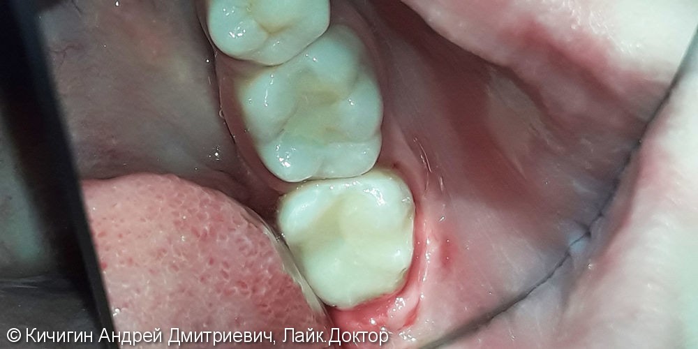 Лечение и реставрация зуба №37 фотополимером Ceram-X - фото №2