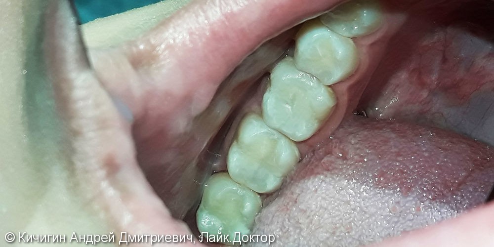 Лечение и реставрация зубов №45/№46/№47/№48 фотополимером Esthet-X - фото №3