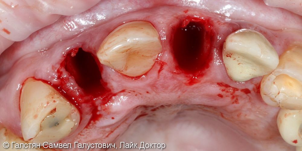 Удаление зубов 12 и 21 с одномоментной установкой 2-ух имплантатов и временные коронки - фото №1