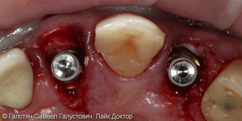 Удаление зубов 12 и 21 с одномоментной установкой 2-ух имплантатов и временные коронки - фото №2