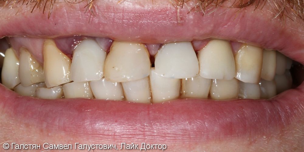Удаление зубов 12 и 21 с одномоментной установкой 2-ух имплантатов и временные коронки - фото №3