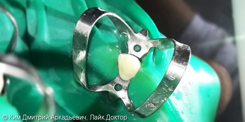 Лечение и реставрация зуба №12 фотополимером российского производства - фото №3