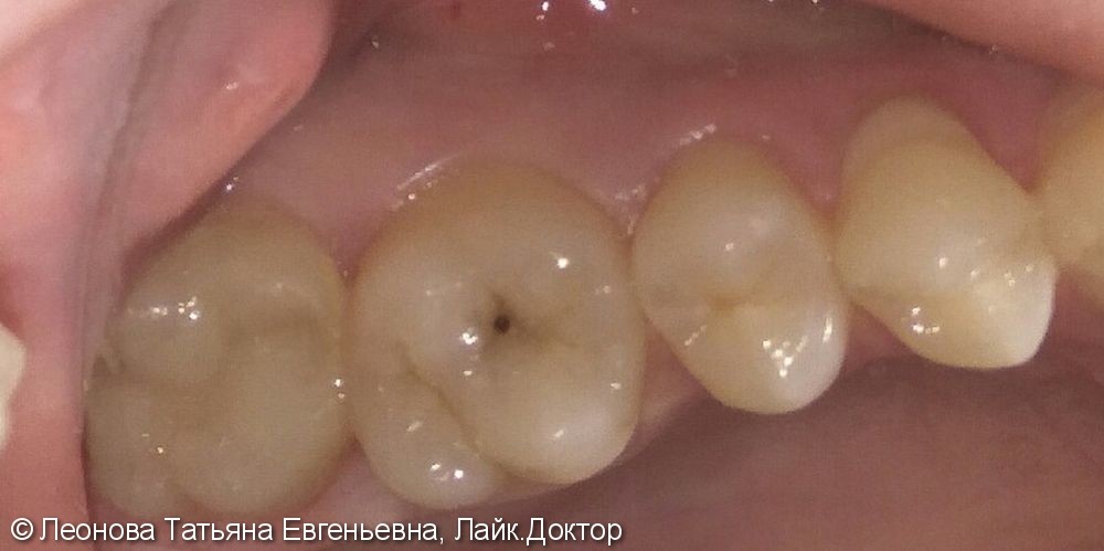 Лечение среднего кариеса жевательного зуба 2.6 - фото №1