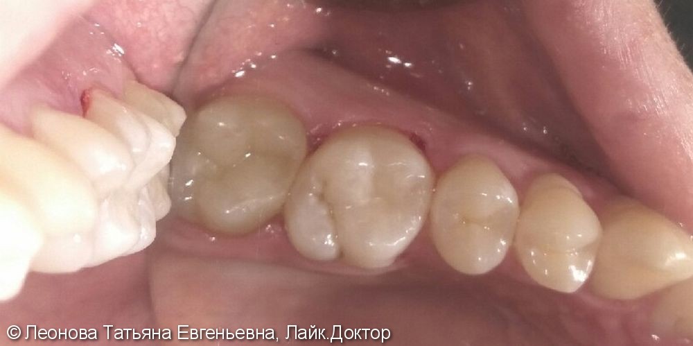 Лечение среднего кариеса жевательного зуба 2.6 - фото №2