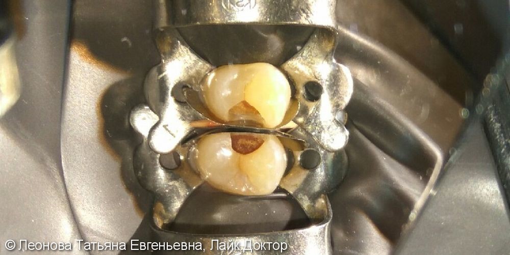 Лечение глубоко кариеса 2-х зубов на верхней челюсти - фото №1