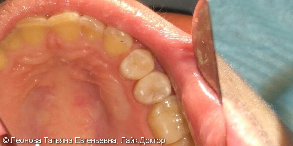 Лечение глубоко кариеса 2-х зубов на верхней челюсти - фото №2