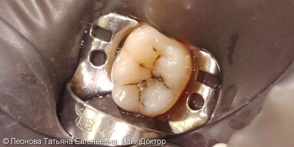 Лечение среднего кариеса на жевательной поверхности зуба 4.6 - фото №1