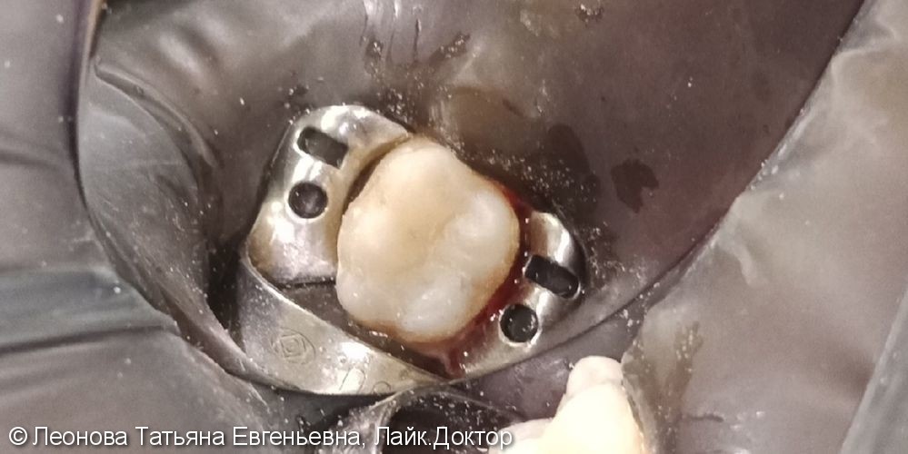 Лечение среднего кариеса на жевательной поверхности зуба 4.6 - фото №2