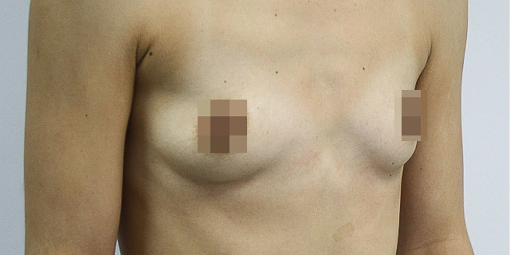 Работа по увеличению груди, вживление имплантатов - фото №1