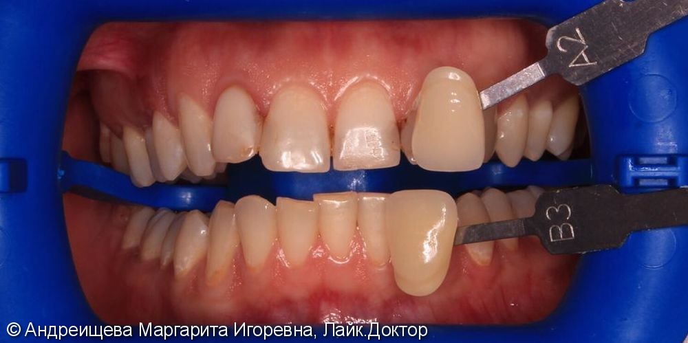 Результат отбеливания зубов системой ZOOM 4 за 2 визита - фото №1