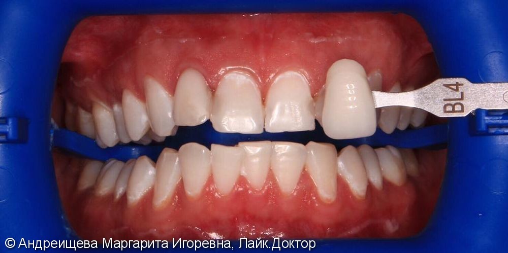 Результат отбеливания зубов системой ZOOM 4 за 2 визита - фото №2