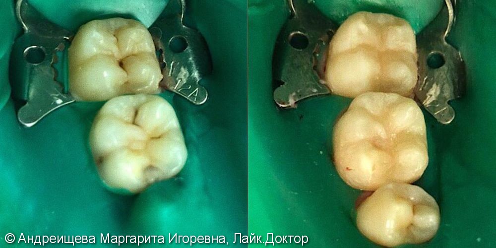 Лечение среднего кариеса 2 зубов, пломбы из материала Estelite (Япония) - фото №1