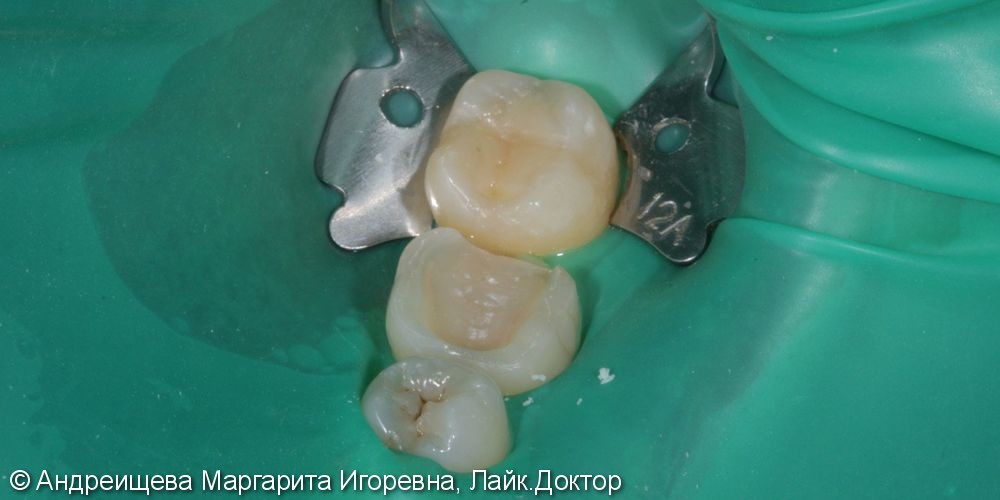 Восстановление зуба накладкой Emax - фото №1