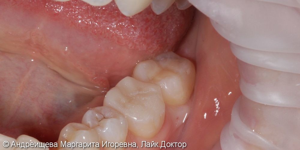 Восстановление зуба накладкой Emax - фото №2