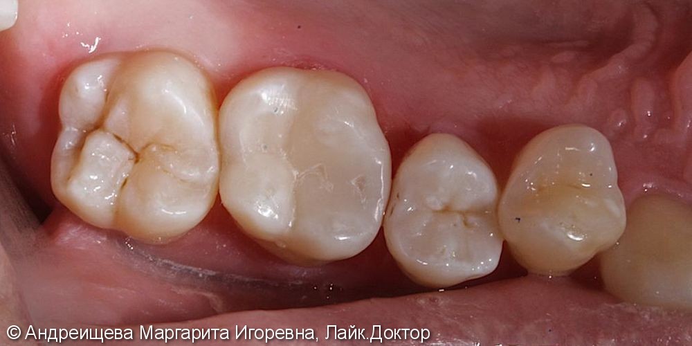 Лечение среднего кариеса 16 зуба - фото №3