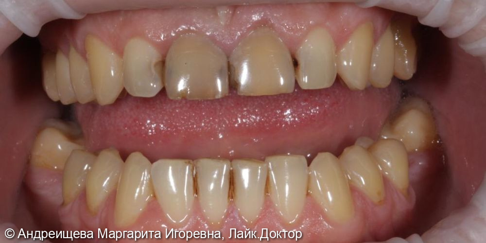 Восстановление зубов керамическими винирами Емах - фото №1