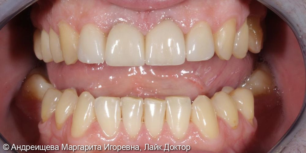 Восстановление зубов керамическими винирами Емах - фото №2