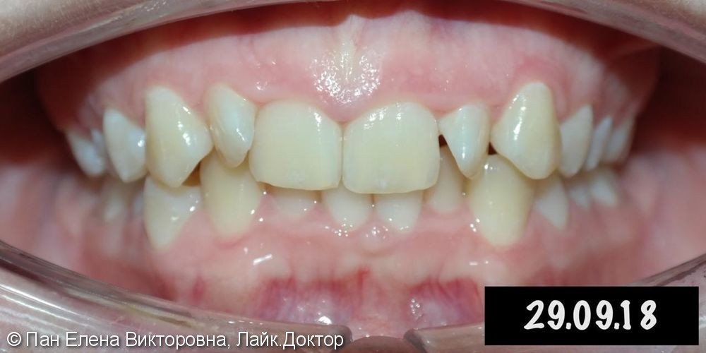 Патология прикуса, сужение верхней и нижней челюсти, недостаток места в зубном ряду - фото №1