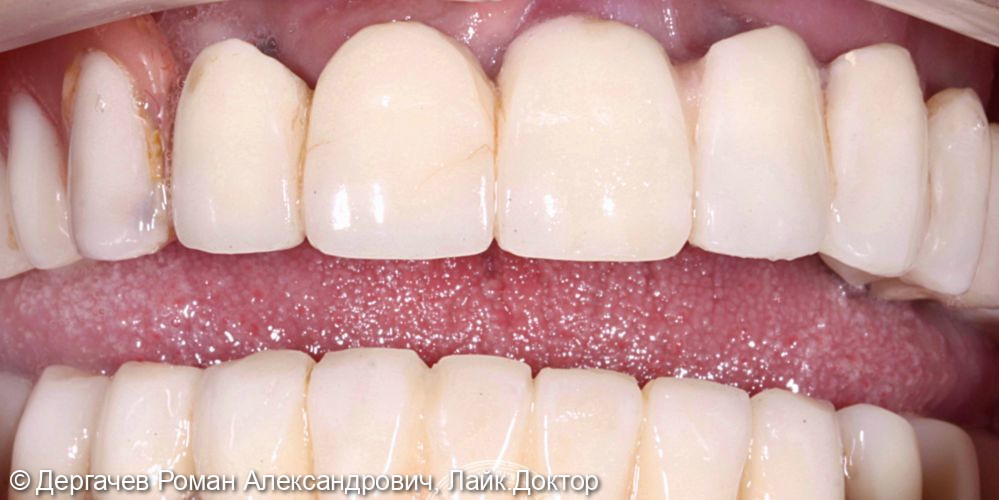 Восстановление полного зубного ряда по протоколу «Все-на-4» - фото №1