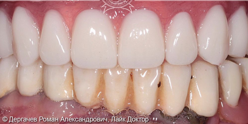 Восстановление полного зубного ряда по протоколу «Все-на-4» - фото №2