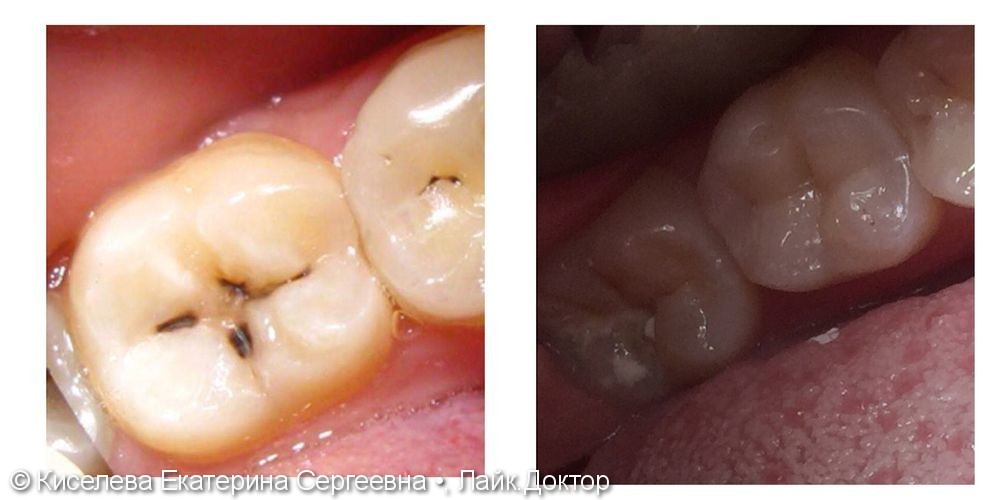 Кратковременные, быстро проходящие боли в области жевательного зуба - фото №1