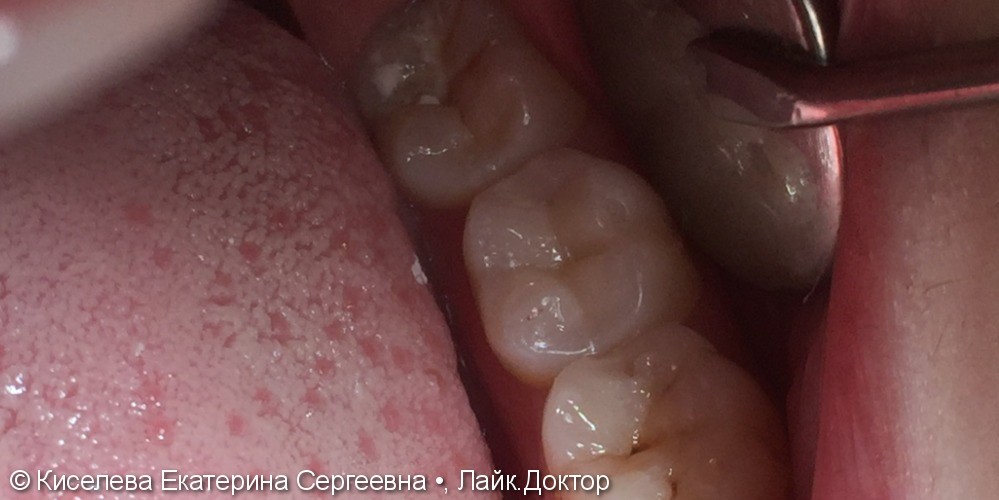 Кратковременные, быстро проходящие боли в области жевательного зуба - фото №2