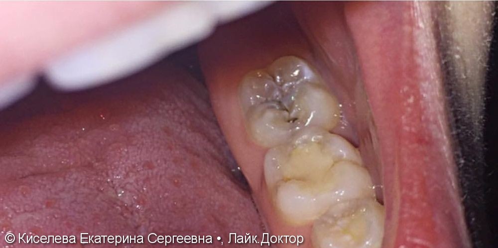 Лечение зуба 3.7 (кариес дентина) - фото №1