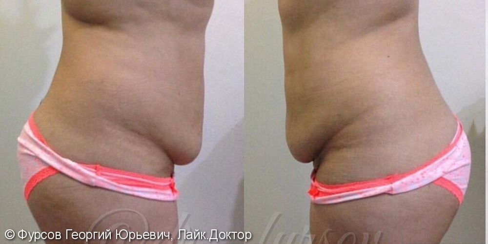Абдоминопластика, фото до и через 3 месяца после операции - фото №1