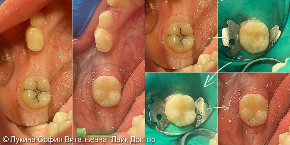 Лечение кариеса шестого зуба - фото №1