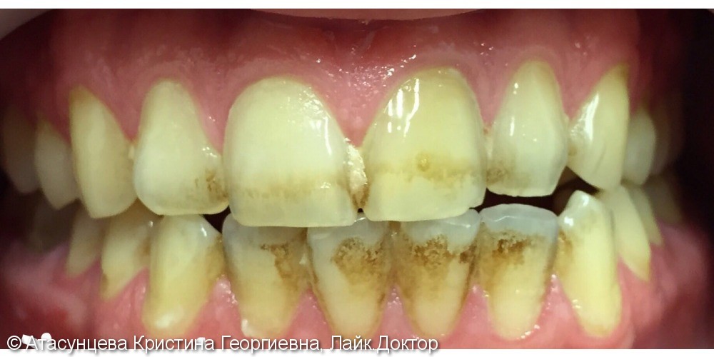 Гигиена полости рта (снятие зубных отложений ультразвуковым скейлером) - фото №1