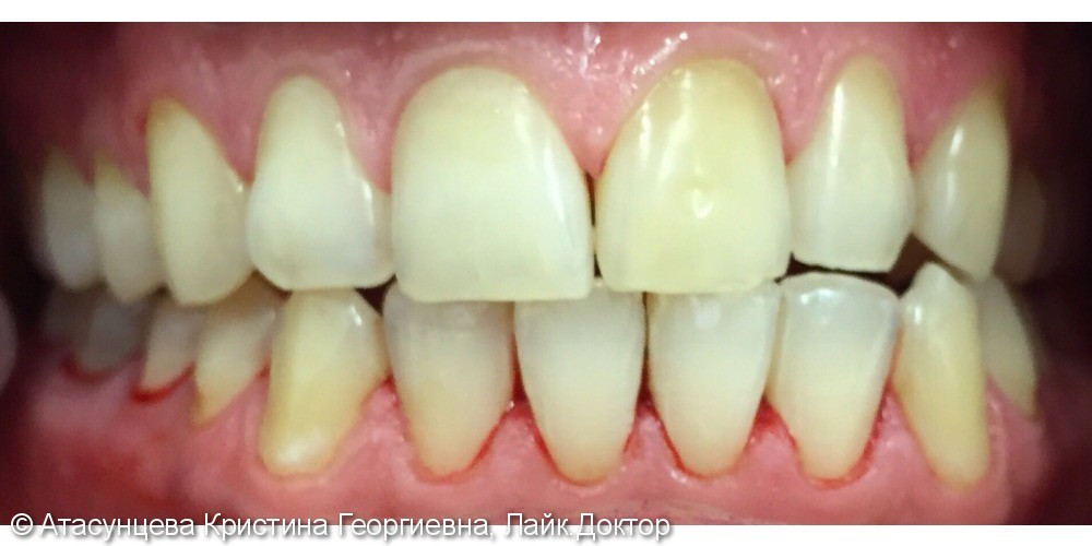 Гигиена полости рта (снятие зубных отложений ультразвуковым скейлером) - фото №2